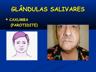 GLÂNDULAS SALIVARESGLÂNDULAS SALIVARES
 CAXUMBACAXUMBA
(PAROTIDITE)(PAROTIDITE)
 
