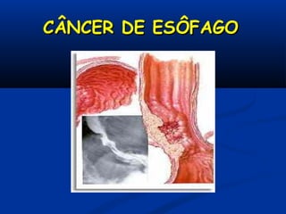 CÂNCER DE ESÔFAGOCÂNCER DE ESÔFAGO
 