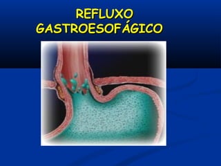 REFLUXOREFLUXO
GASTROESOFÁGICOGASTROESOFÁGICO
 