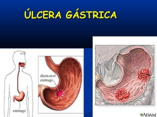ÚLCERA GÁSTRICAÚLCERA GÁSTRICA
 