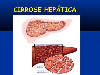 CIRROSE HEPÁTICACIRROSE HEPÁTICA
 