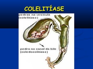 COLELITÍASECOLELITÍASE
 