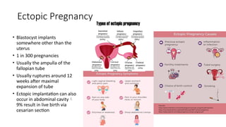 Ectopic Pregnancy
• Blastocyst implants
somewhere other than the
uterus
• 1 in 300 pregnancies
• Usually the ampulla of the
fallopian tube
• Usually ruptures around 12
weeks after maximal
expansion of tube
• Ectopic implantation can also
occur in abdominal cavity
9% result in live birth via
cesarian section
 