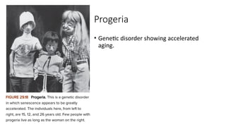Progeria
• Genetic disorder showing accelerated
aging.
 