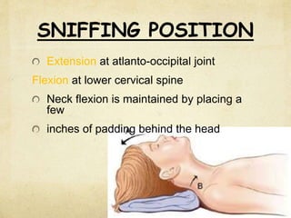 SNIFFING POSITION
Extension at atlanto-occipital joint
Flexion at lower cervical spine
Neck flexion is maintained by placing a
few
inches of padding behind the head
 