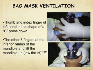BAG MASK VENTILATION
•Thumb and index finger of
left hand in the shape of a
“C” press down
•The other 3 fingers at the
inferior ramus of the
mandible and lift the
mandible up (jaw thrust) “E”
C
E
 