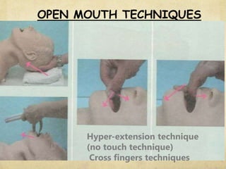 OPEN MOUTH TECHNIQUES
Hyper-extension technique
(no touch technique)
Cross fingers techniques
 