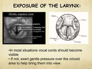 EXPOSURE OF THE LARYNX:
•In most situations vocal cords should become
visible
• If not, exert gentle pressure over the cricoid
area to help bring them into view
 