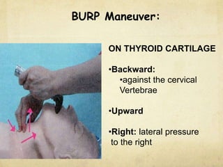 BURP Maneuver:
ON THYROID CARTILAGE
•Backward:
•against the cervical
Vertebrae
•Upward
•Right: lateral pressure
to the right
 