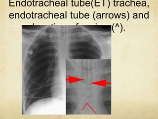 Endotracheal tube(ET) trachea,
endotracheal tube (arrows) and
location of carina (^).
 