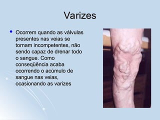 Varizes
Varizes
 Ocorrem quando as válvulas
Ocorrem quando as válvulas
presentes nas veias se
presentes nas veias se
tornam incompetentes, não
tornam incompetentes, não
sendo capaz de drenar todo
sendo capaz de drenar todo
o sangue. Como
o sangue. Como
conseqüência acaba
conseqüência acaba
ocorrendo o acúmulo de
ocorrendo o acúmulo de
sangue nas veias,
sangue nas veias,
ocasionando as varizes
ocasionando as varizes
 