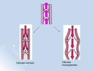 Válvulas normais Válvulas
incompetentes
 