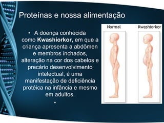 Proteínas e nossa alimentação

   • A doença conhecida
como Kwashiorkor, em que a
criança apresenta a abdômen
     e membros inchados,
alteração na cor dos cabelos e
   precário desenvolvimento
       intelectual, é uma
  manifestação de deficiência
 protéica na infância e mesmo
          em adultos.
              •
 