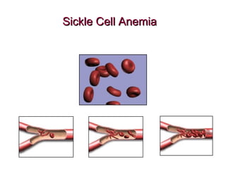 Sickle Cell AnemiaSickle Cell Anemia
 