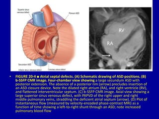 Measure Rims Asd Mri 20 congenital heart disease Dr. Muhammmad Bin Zulfiqar | PPTX