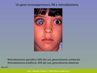 Figura 20.7 Peter J Russell,  Genetica  © 2010 Pearson Italia S.p.A Un gene oncosoppressore: RB e retinoblastoma  Retinoblastoma sporadico: 60% dei casi, generalmente unilaterale Retinoblastoma ereditario: 40% dei casi, generalmente bilaterale 