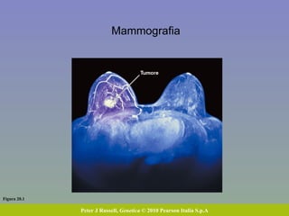 Figura 20.1 Peter J Russell,  Genetica  © 2010 Pearson Italia S.p.A Mammografia 