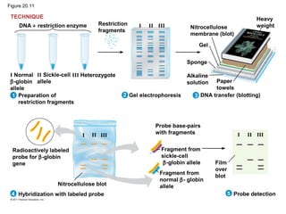 Figure 20.11
DNA + restriction enzyme
321
4
TECHNIQUE
I Normal
β-globin
allele
II Sickle-cell
allele
III Heterozygote
Restriction
fragments
Nitrocellulose
membrane (blot)
Heavy
weight
Gel
Sponge
Alkaline
solution Paper
towels
III III
III III III III
Preparation of
restriction fragments
Gel electrophoresis DNA transfer (blotting)
Radioactively labeled
probe for β-globin
gene
Nitrocellulose blot
Probe base-pairs
with fragments
Fragment from
sickle-cell
β-globin allele
Fragment from
normal β- globin
allele
Film
over
blot
Hybridization with labeled probe Probe detection5
 
