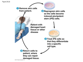 Figure 20.22
Remove skin cells
from patient. 2
1
3
4
Reprogram skin cells
so the cells become
induced pluripotent
stem (iPS) cells.
Patient with
damaged heart
tissue or other
disease
Return cells to
patient, where
they can repair
damaged tissue.
Treat iPS cells so
that they differentiate
into a specific
cell type.
 