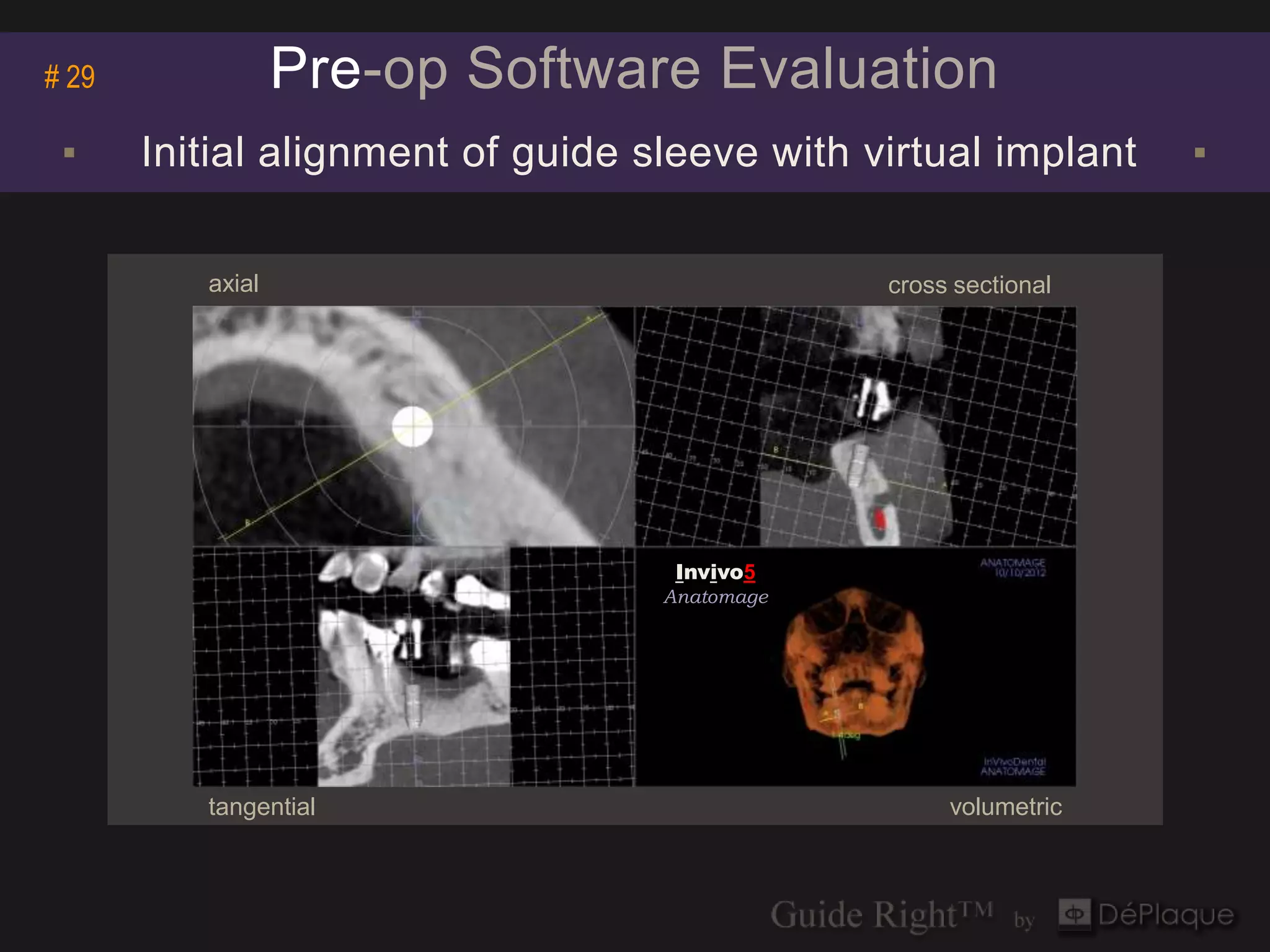 # 29              Pre-op Software Evaluation
 ▪     Initial alignment of guide sleeve with virtual implant    ▪

          axial                                cross sectional




                                    Invivo5
                                   Anatomage




          tangential                                volumetric
 