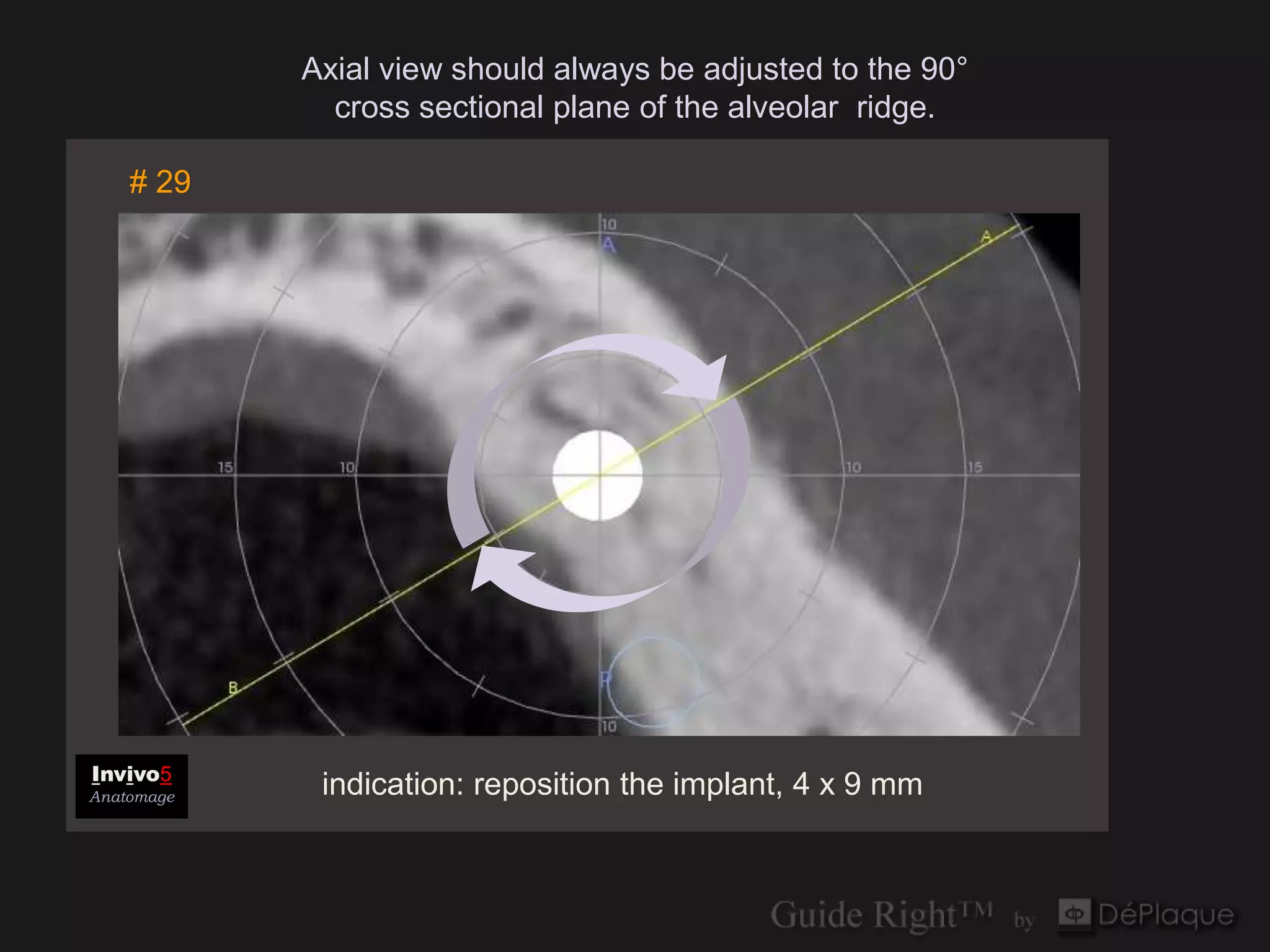 Axial view should always be adjusted to the 90°
              cross sectional plane of the alveolar ridge.

    # 29




Invivo5
Anatomage    indication: reposition the implant, 4 x 9 mm
 