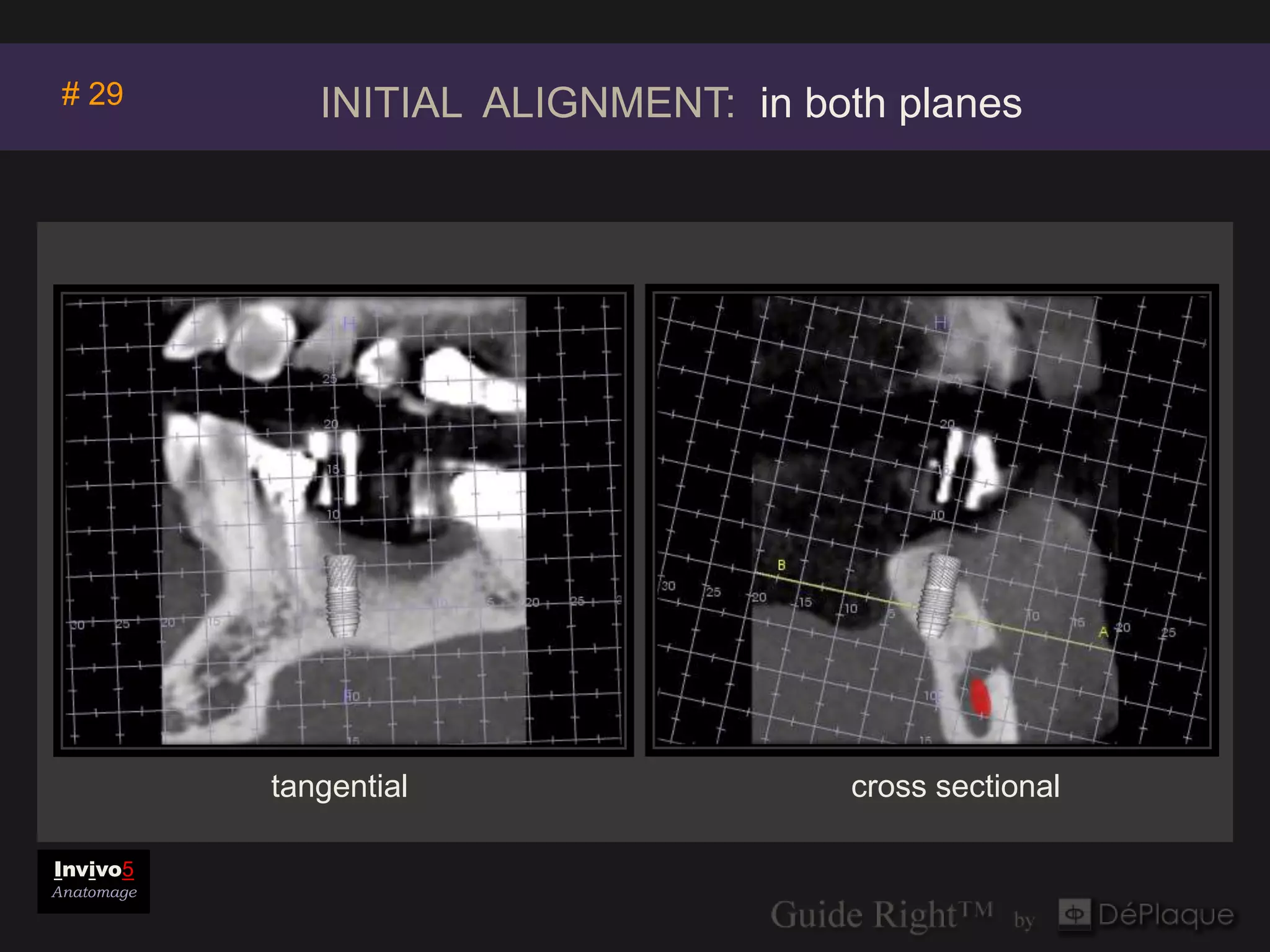# 29          INITIAL ALIGNMENT: in both planes




            tangential                 cross sectional

Invivo5
Anatomage
 