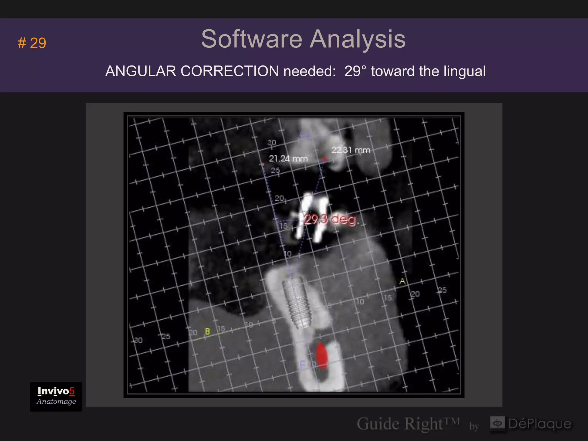 Invivo5
# 29                      Software Analysis
                                    Anatomage

              ANGULAR CORRECTION needed: 29° toward the lingual




  Invivo5
  Anatomage
 
