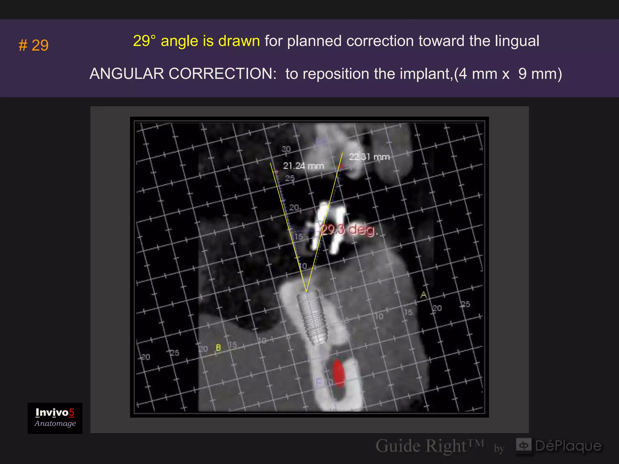 Invivo5
                   29° angle is drawn for planned correction toward the lingual
# 29                                      Anatomage

              ANGULAR CORRECTION: to reposition the implant,(4 mm x 9 mm)




  Invivo5
  Anatomage
 