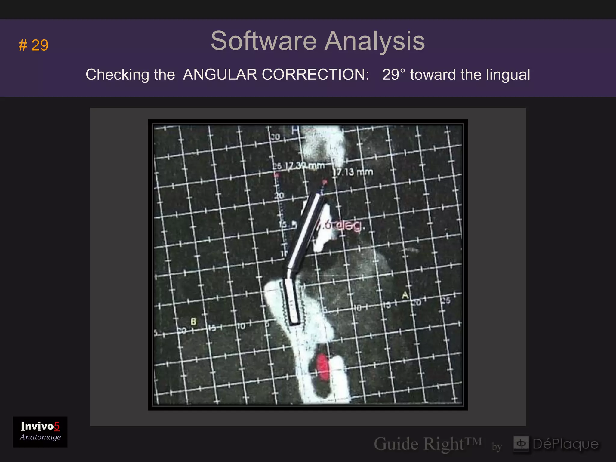 Invivo5
# 29                       Software Analysis
                                     Anatomage

            Checking the ANGULAR CORRECTION: 29° toward the lingual




Invivo5
Anatomage
 