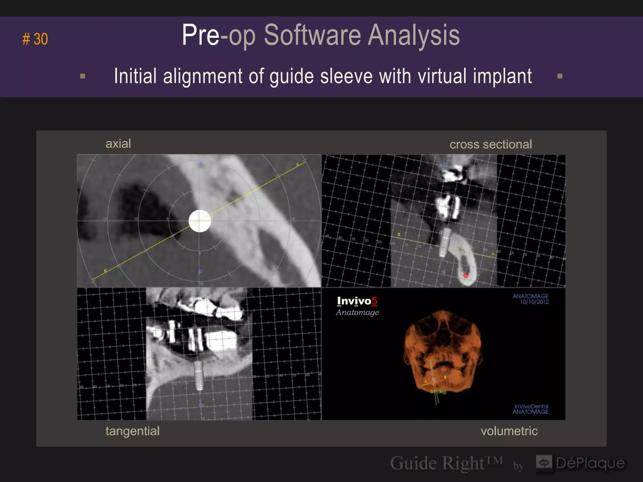 # 30                    Pre-op Software Analysis
       ▪    Initial alignment of guide sleeve with virtual implant       ▪


           axial                                       cross sectional




                                         Invivo5
                                        Invivo5
                                        Anatomage
                                        Anatomage




           tangential                                       volumetric
 