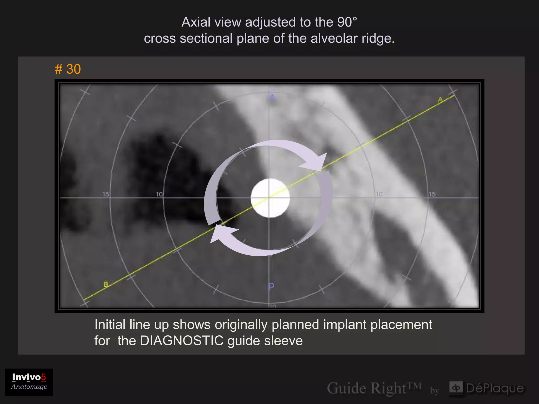 Axial view adjusted to the 90°
                           cross sectional plane of the alveolar ridge.

            # 30




                   Initial line up shows originally planned implant placement
                   for the DIAGNOSTIC guide sleeve

Invivo5
Anatomage
 