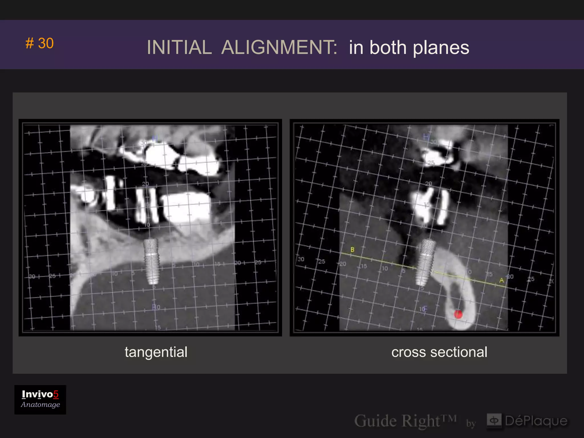 # 30          INITIAL ALIGNMENT: in both planes




            tangential                  cross sectional

Invivo5
Anatomage
 
