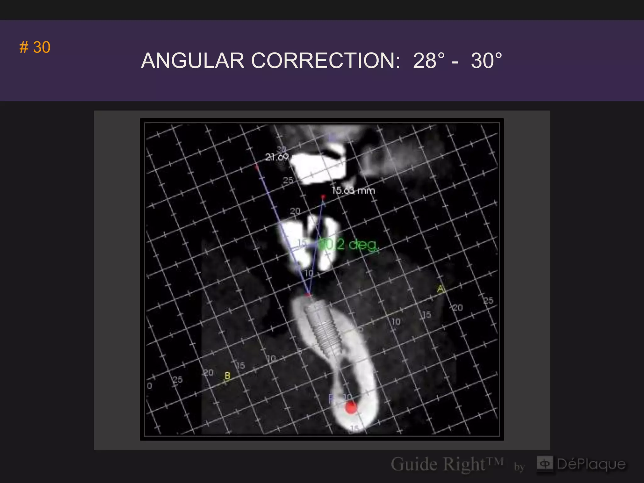 Invivo5
# 30               Anatomage
       ANGULAR CORRECTION: 28° - 30°
 
