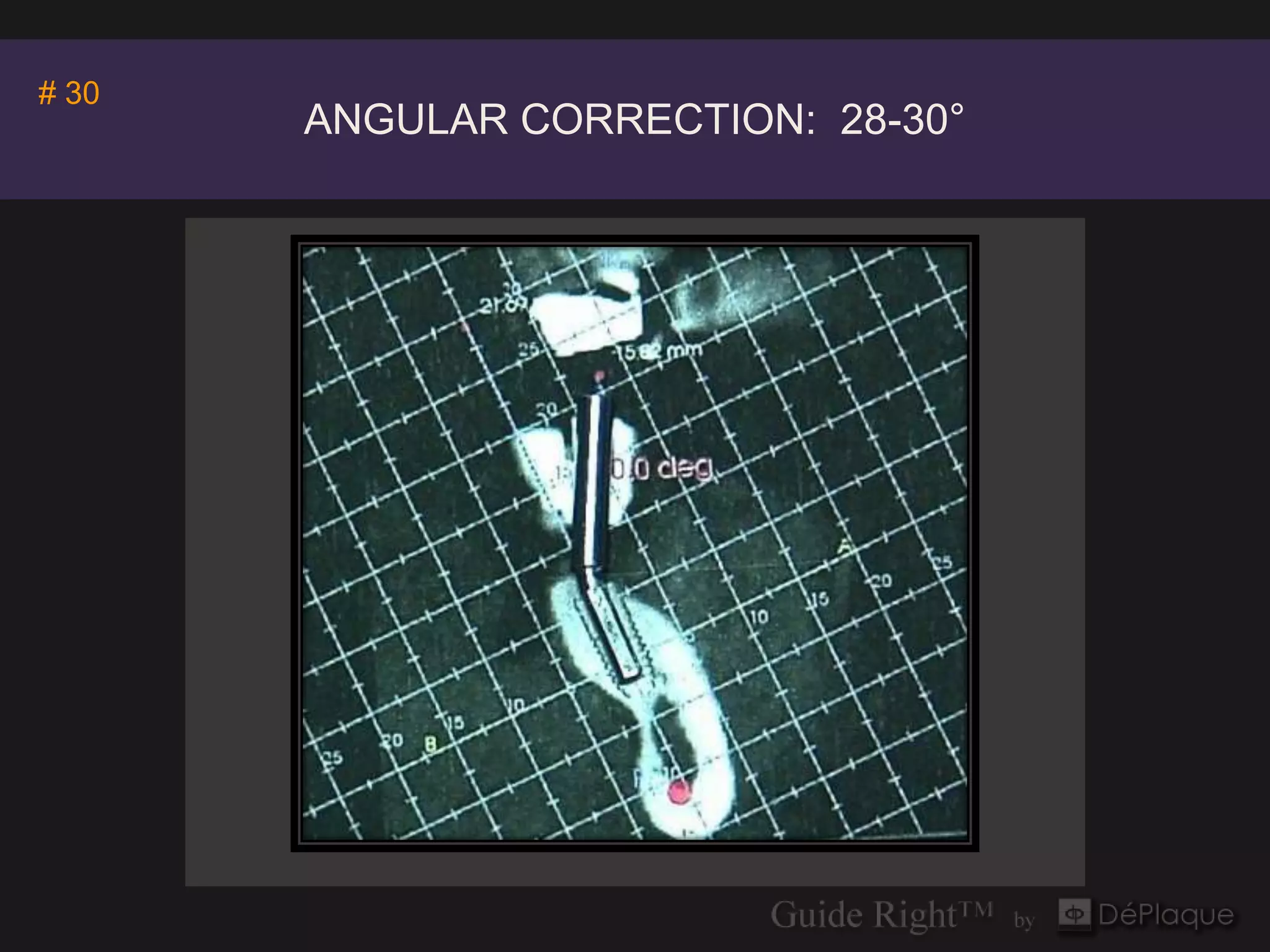 Invivo5
# 30              Anatomage
       ANGULAR CORRECTION: 28-30°
 