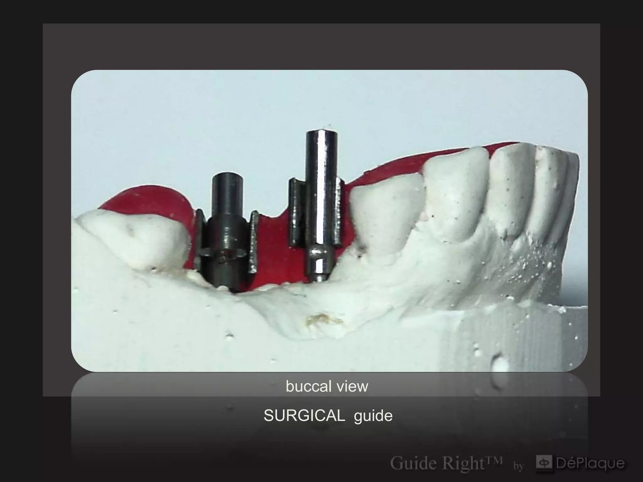 buccal view
SURGICAL guide
 
