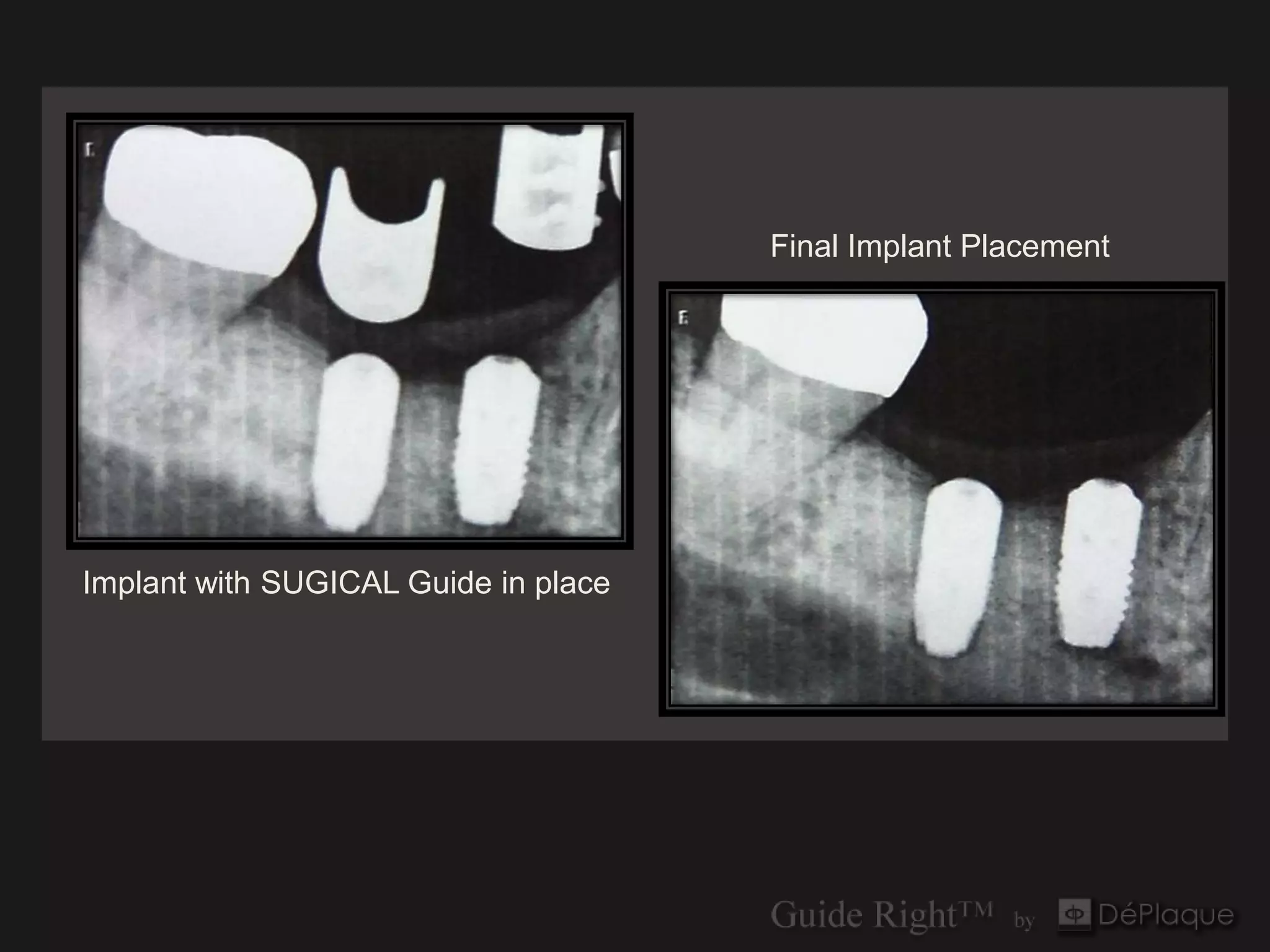 Final Implant Placement




Implant with SUGICAL Guide in place
 