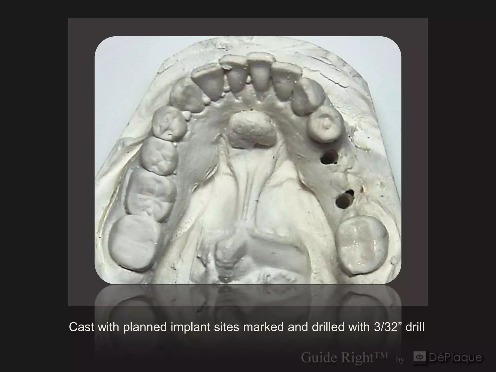 Cast with planned implant sites marked and drilled with 3/32” drill
 