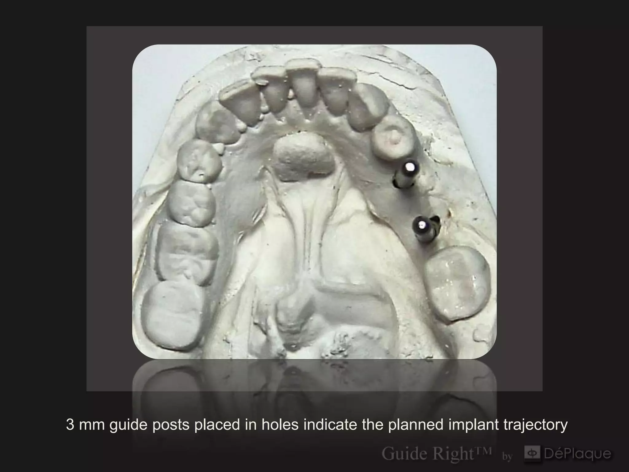 3 mm guide posts placed in holes indicate the planned implant trajectory
 