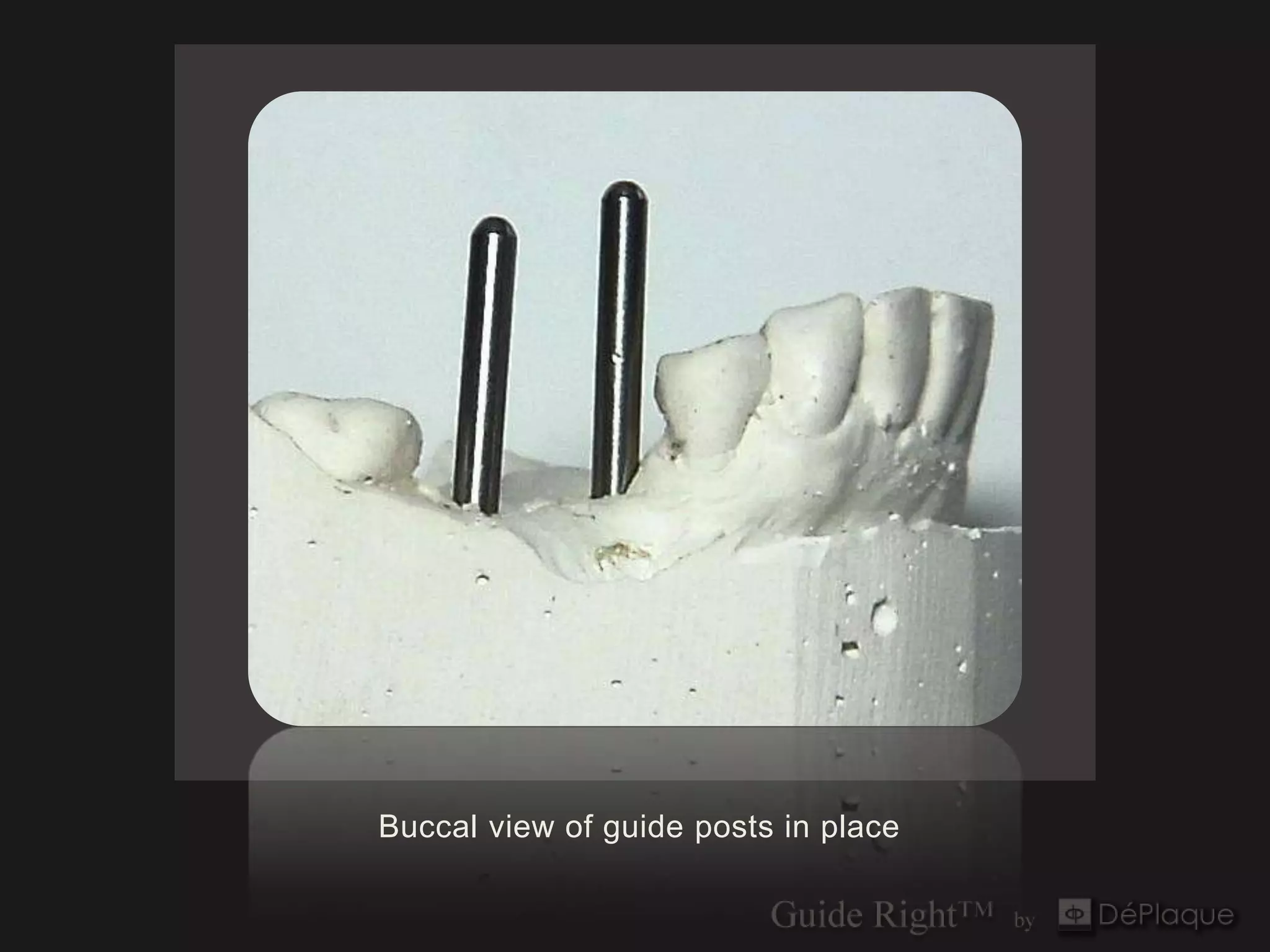 Buccal view of guide posts in place
 