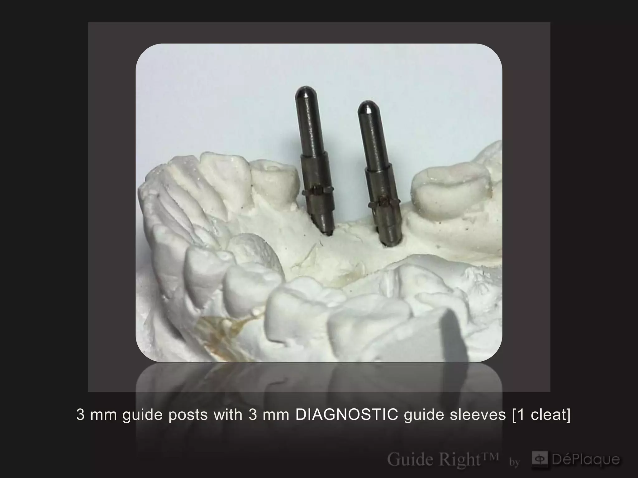 3 mm guide posts with 3 mm DIAGNOSTIC guide sleeves [1 cleat]
 