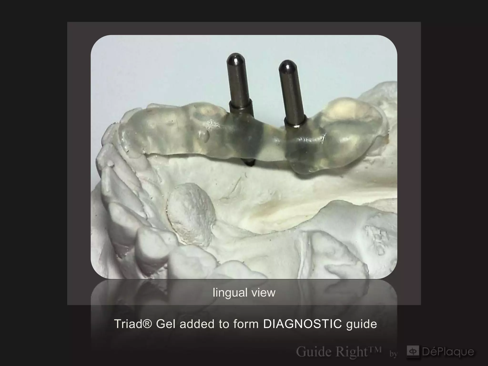 lingual view

Triad® Gel added to form DIAGNOSTIC guide
 