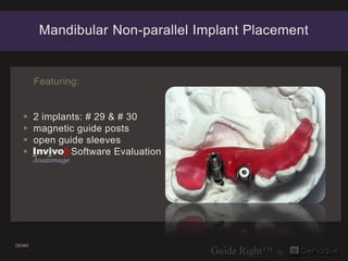 Mandibular Non-parallel Implant Placement


       Featuring:


      2 implants: # 29 & # 30
      magnetic guide posts
      open guide sleeves
      Invivo5 Software Evaluation
       Anatomage




DEMA
 