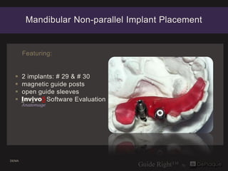 Mandibular Non-parallel Implant Placement


       Featuring:


      2 implants: # 29 & # 30
      magnetic guide posts...