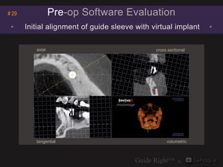 # 29              Pre-op Software Evaluation
 ▪     Initial alignment of guide sleeve with virtual implant    ▪

         ...
