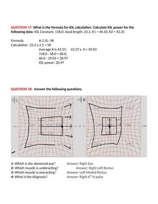 QUESTION 17: What is the formula for IOL calculation. Calculate IOL power for the
following data: IOL Constant: 118.0; Axial length: 23.2, K1 = 44.50, K2 = 42.25
Formula: A-2.5L-.9K
Calculation: 23.2 x 2.5 = 58
Average K is 43.37; 43.37 x .9 = 39.03
118.0 - 58.0 = 60.0;
60.0 - 39.03 = 20.97
IOL power: 20.97
QUESTION 18: Answer the following questions.
1- Which is the abnormal eye? Answer: Right Eye
2- Which muscle is underacting? Answer: Right Left Rectus
3- Which muscle is overacting? Answer: Left Medial Rectus
4- What is the diagnosis? Answer: Right 6th
N palsy
 