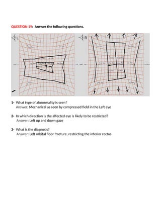 QUESTION 19: Answer the following questions.
1- What type of abnormality is seen?
Answer: Mechanical as seen by compressed field in the Left eye
2- In which direction is the affected eye is likely to be restricted?
Answer: Left up and down gaze
3- What is the diagnosis?
Answer: Left orbital floor fracture, restricting the inferior rectus
 