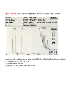 QUESTION 20: A-scan ultrasound printout. Name the labels C, L1, L2 and R
C: cornea front surface, the second part of C is the reflection from its rear surface.
L1: front surface of the eye lens
L2: from its rear surface.
R: retina, and the others from the sclera
 