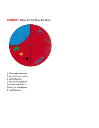 QUESTION 9: Retinal drawing. Name the labels.
A (blue)Detached retina
B (green) Vitreous opacity
C (yellow) Exudate
D (black) Retinal pigment
E (hatched blue) Lattice
F (blue-red) retinal break
G (red) Flat retina
 