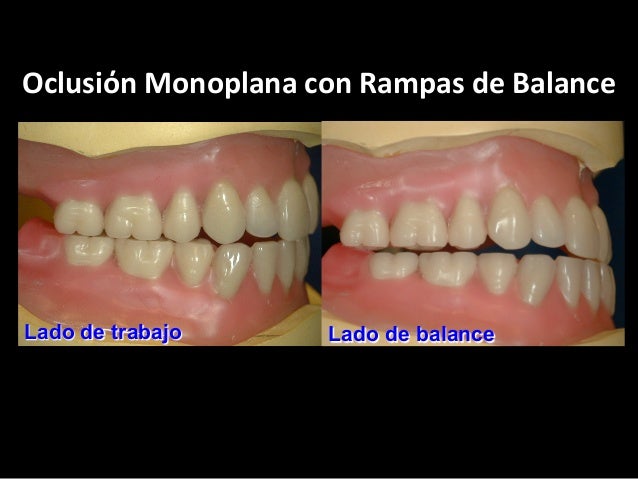 20 oclusion monoplana con rampas de balance