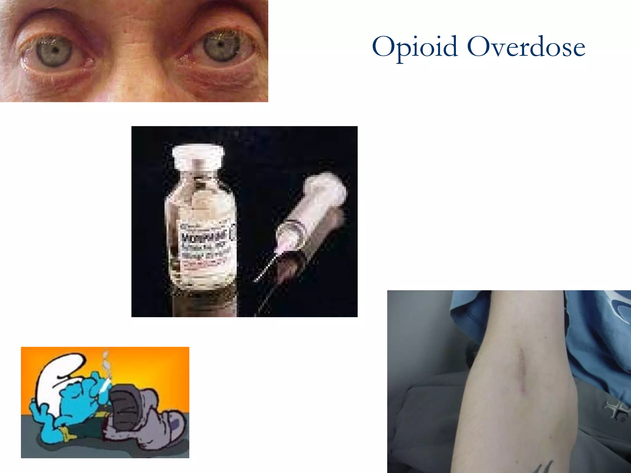 Opioid Overdose  